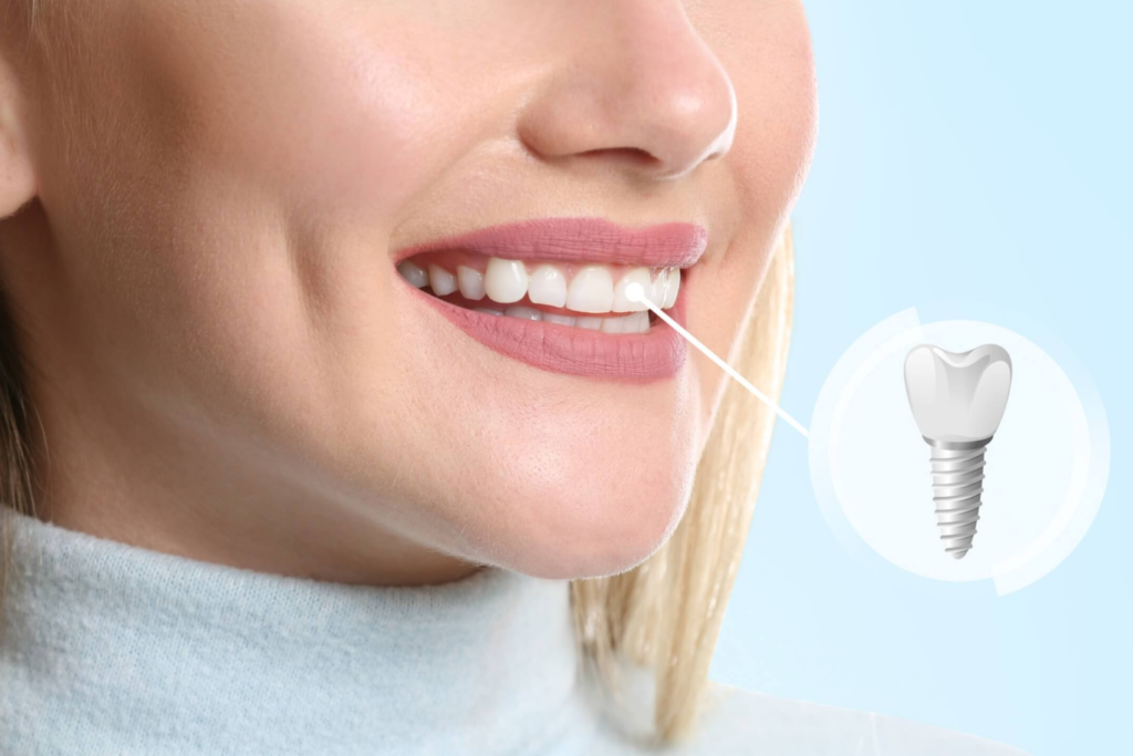 Dental Implants​