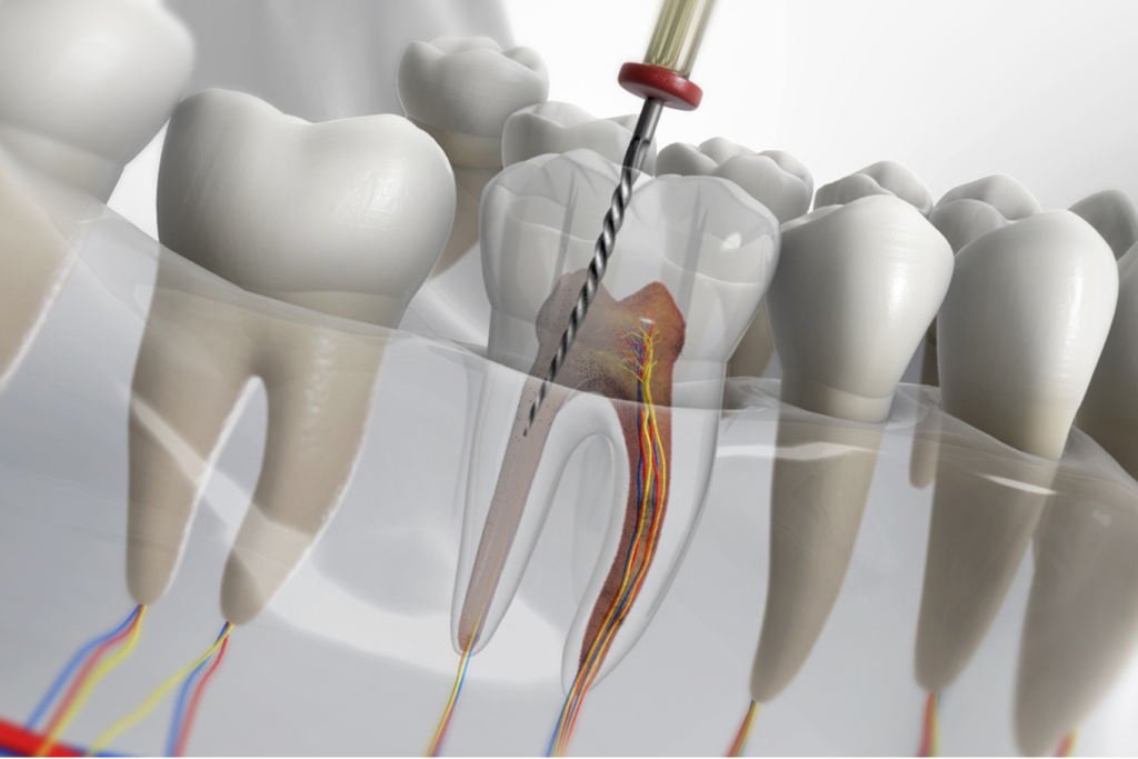 Painless Root Canal Treatment/ RCT​