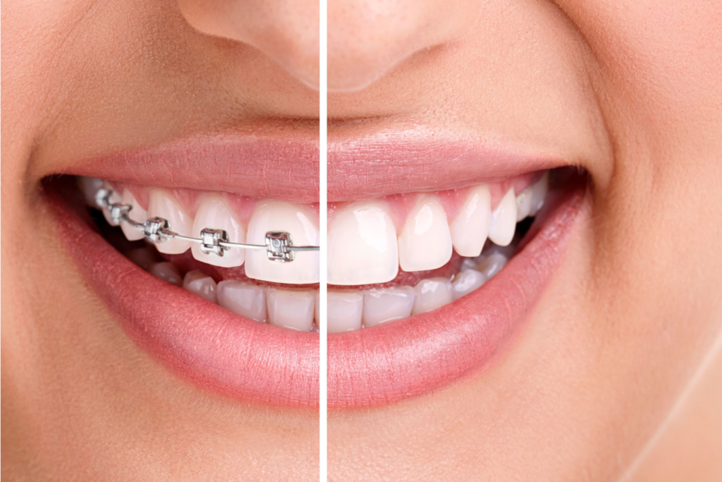 Teeth Alignment / Orthodontics​